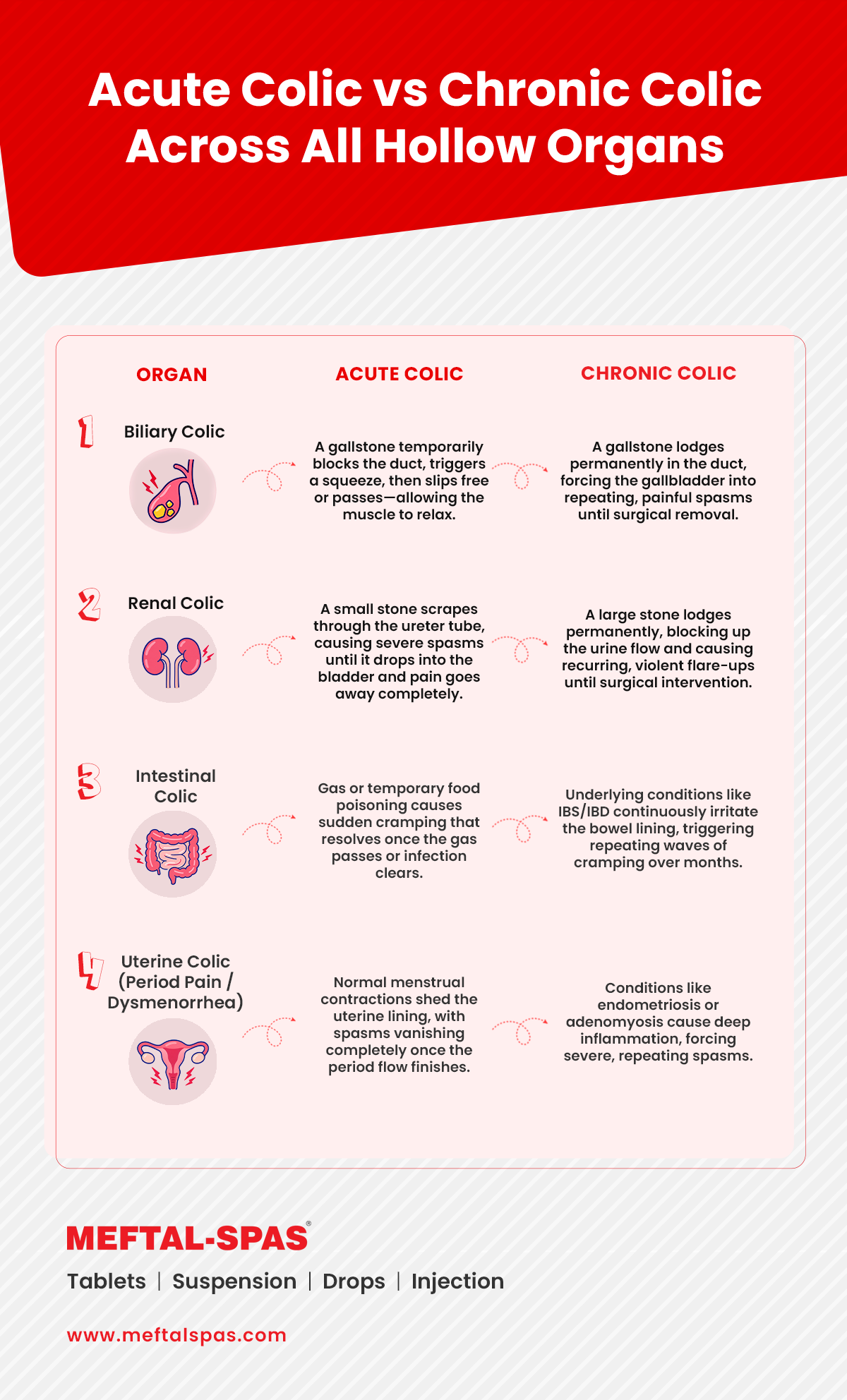 Table comparing acute and chronic colic across four organs: biliary colic, kidney colic, intestinal colic, and uterine colic. It explains that acute colic is caused by temporary blockage, irritation, or normal contractions that resolve, while chronic colic involves persistent or recurring conditions that cause repeated pain. Examples include gallstones, kidney stones, IBS or IBD, and endometriosis or adenomyosis.